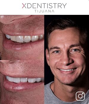 Composite Veneers in Mexico: How much are, Materials, Cases, Reviews