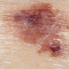 Example Of Pigmented Skin Lesion Left Traditional Imaging Technique