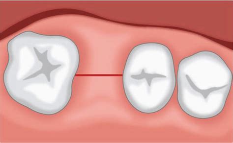 Flap Techniques In Dentoalveolar Surgery Intechopen