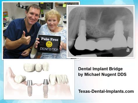 Dental Implant Bridges For Multiple Teeth Best Dental Implant Care