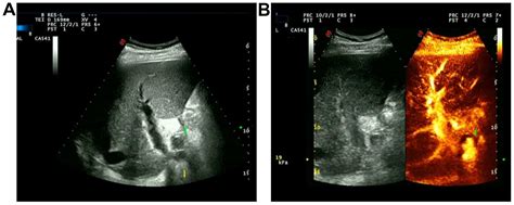 Hepatic Artery Ultrasound