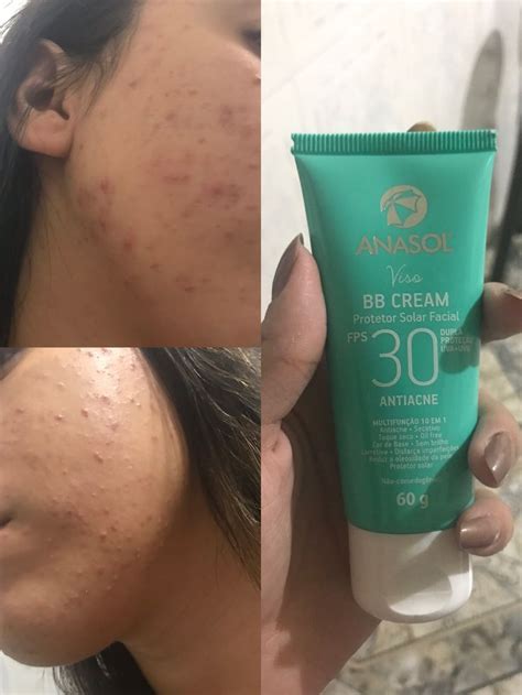 BB Cream Protetor Facial Anasol Antiacne