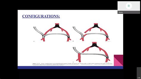 Aortoiliac Disease Open Extra Anatomic Bypass Youtube