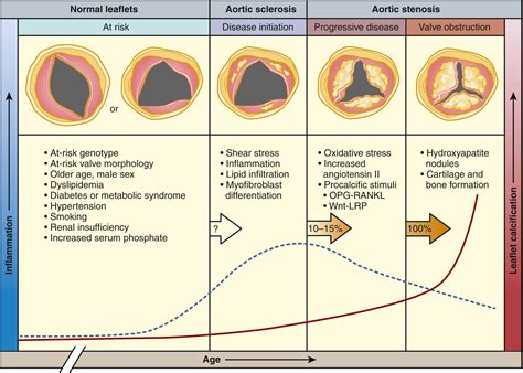 Aortic Valve Stenosis Clinical Tree