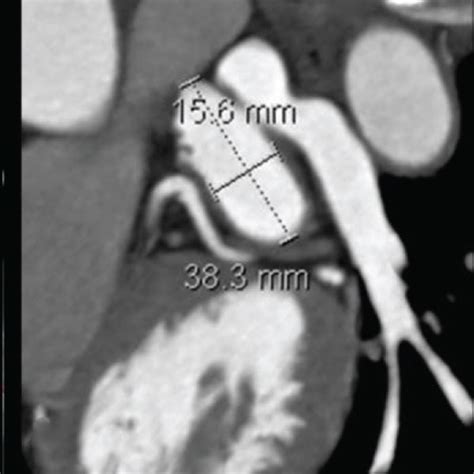 An Example Of Cardiac CTA Images Illustrating The Measurement Of The