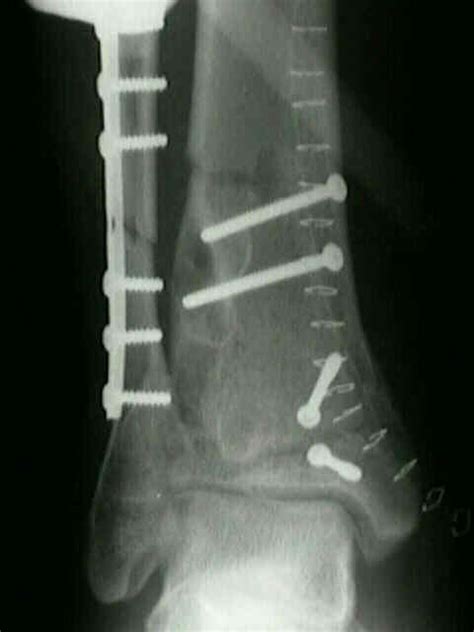 Tibial Plafond Fracture Anatomy