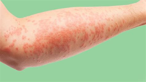 Eczema Symptoms Treatment Causes More