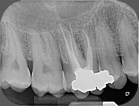 Molar Tooth Implant - Specialist Implant Clinic