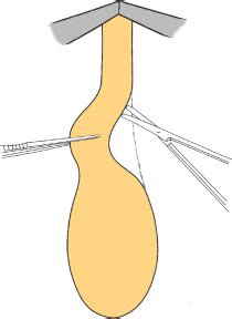 Bulbar Urethroplasty With Dorsal Onlay Buccal Mucosal Graft And Fibrin