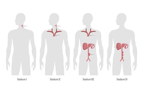 Hodgkin Lymphom Diagnose Bms Pflege Onkologie