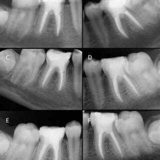 After 3 A B And 6 Month C D Follow Up Radiographs Showed Further