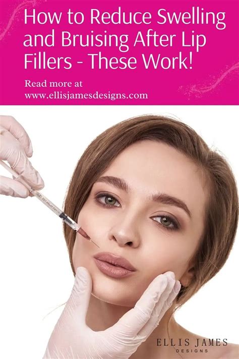 How To Reduce Swelling And Bruising After Lip Fillers These Work In