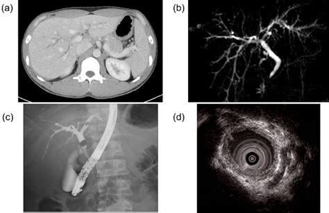 Figure1a Ct Showing Dilation Of The Intrahepatic Bile Duct B Mrcp Download Scientific