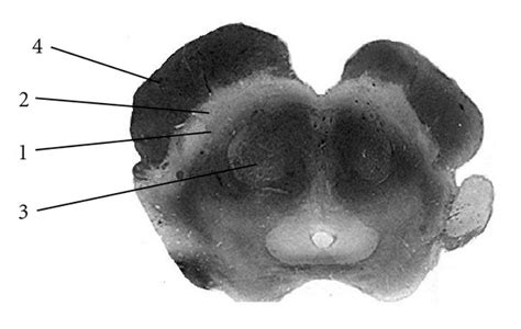 Substantia Nigra The Normal Substantia Nigra Anatomy Is Shown On A