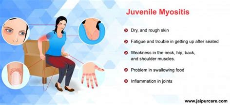 Myositis Causes Symptoms Treatment In Jaipur Dr Bhupendra Vaishnav