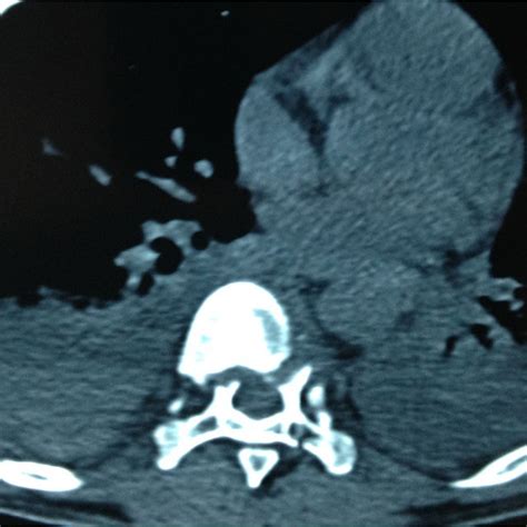 Horizontal Computed Tomography Scans Showed A Large Bilateral