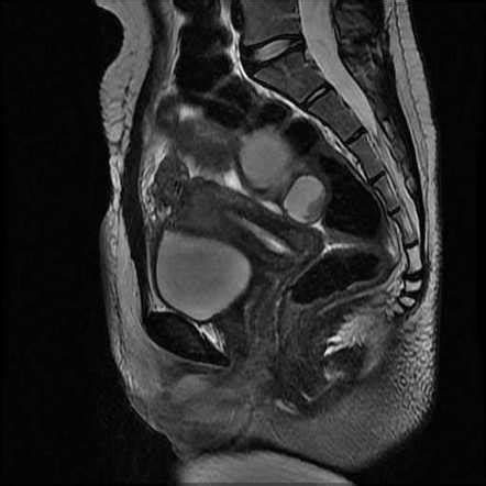 Unicornuate Uterus With Contralateral Rudimentary Horn Radiology Case