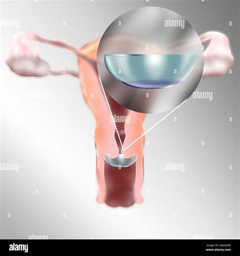 Spermicide diaphragm hi-res stock photography and images - Alamy