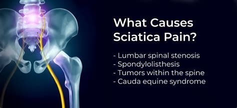 Sciatica Pain Causes, Symptoms, Treatments, and Home Remedies