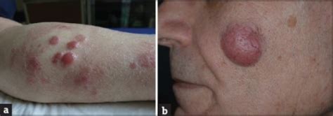 Typical Aspect Of Primary Cutaneous Diffuse Large B Cel Open I