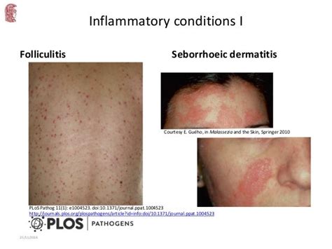 Update On Malassezia Associated Skin Diseases1