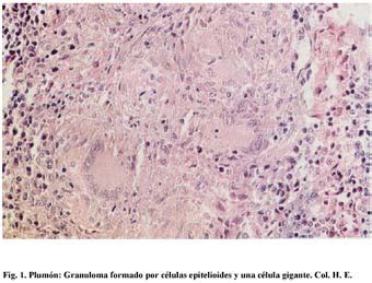 Importancia De La Biopsia En El Diagn Stico De Histoplasmosis