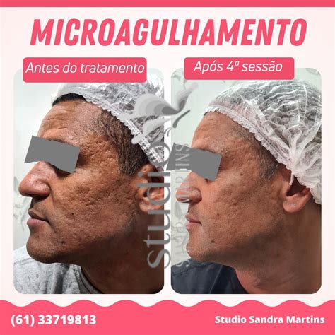 Microagulhamento para que serve Sandra Martins Taguatinga Estética Facial