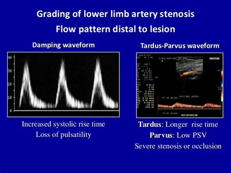 Lower Extremity Arterial Ultrasound Radiology