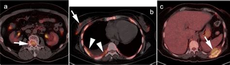 Aggressive myeloma with multiple extramedullary sites of tumor... | Download Scientific Diagram