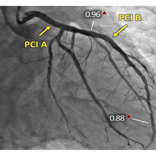 A Angiographic Image Of Post PCI FFR In The Distal Left Main Stem And