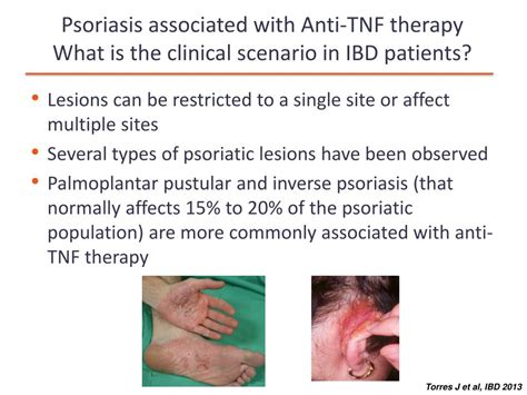 Ppt Understanding And Managing Side Effects Due To Immunomodulators And Biologics Powerpoint