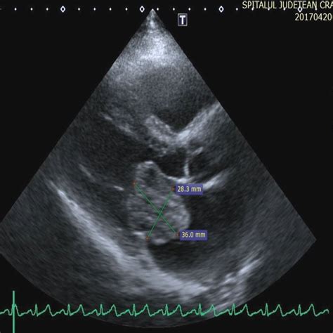 Chest X Ray Showing Dilatation Of Right Atrium Left Atrium And