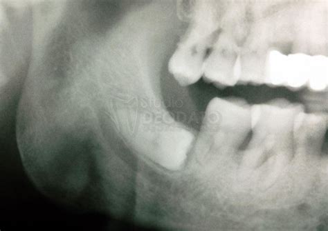 Estrazioni Di Denti Del Giudizio Inclusi Studio Deodato