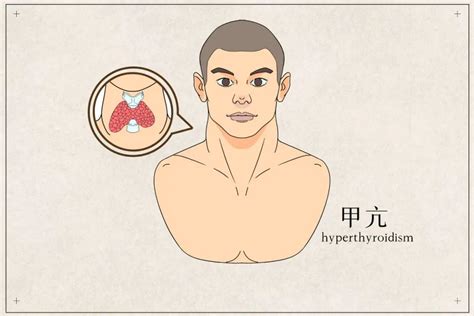 国医大师李佃贵：治疗甲状腺功能亢进经验