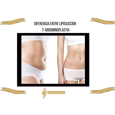 Diferencia Entre Liposucci N Y Abdominoplastia