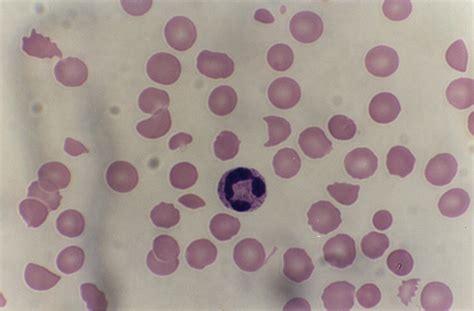 Differential Diagnosis Of Normocytic Anemia Medical Zone