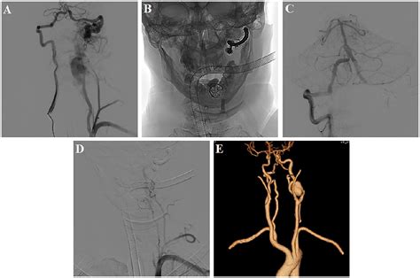 Frontiers New Aneurysm Formation After Endovascular Embolization Of A