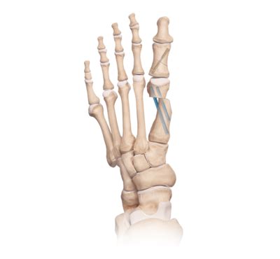 5th Metatarsal Osteotomy