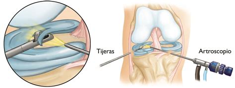 ¿en Qué Consiste Una Artroscopia De Rodilla Itramed