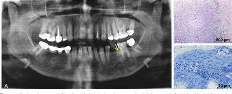 Figure 1 From Hypercementosis And Odontogenic Epithelial Hyperplasia