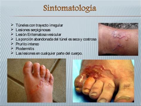 Anquilostomiasis Y Larva Migrans Cutánea