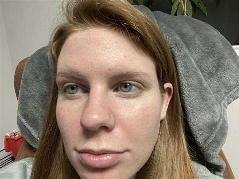 Update 4 Days Post Microneedling Most Of The Dry Skin Has Fallen Off My Skin Broke Out More