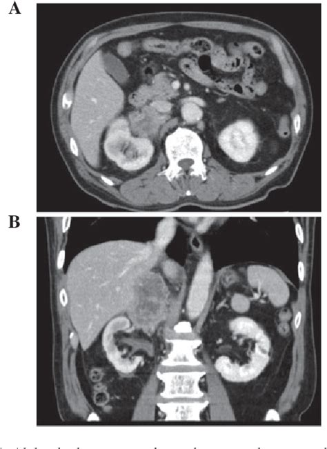 Figure 1 From Carcinoma Like Nonfunctional Pheochromocytoma In The Right Adrenal Gland A Case