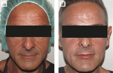 Facial Sculpting With Stem Cells Prime Journal