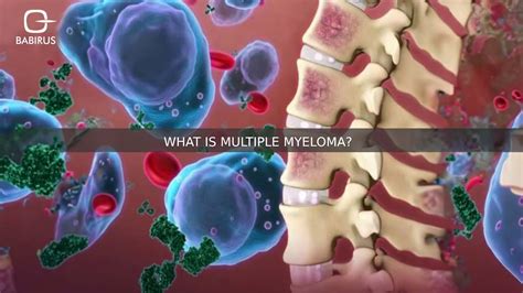 What Is Multiple Myeloma Symptoms And Treatment Babirus Llc