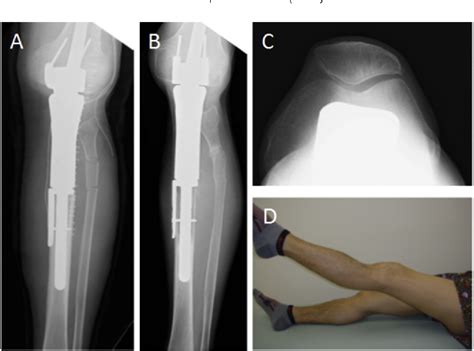 Figure From Extensor Reconstruction Of The Knee Using The Fibular