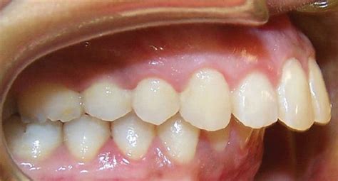 Maxillary Prognathism Overbite