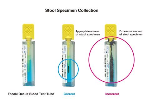 How To Collect Stool Specimen Prevent Colorectal Cancer