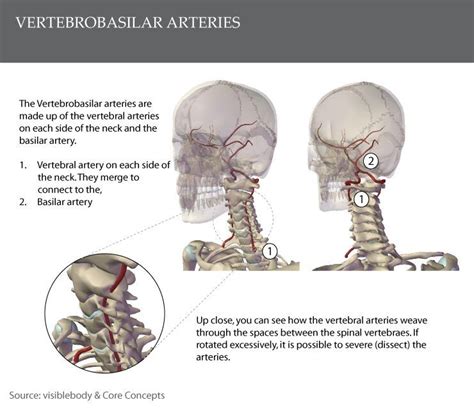 Vertebrobasilar Insufficiency: Getting Your Neck 'Cracked'