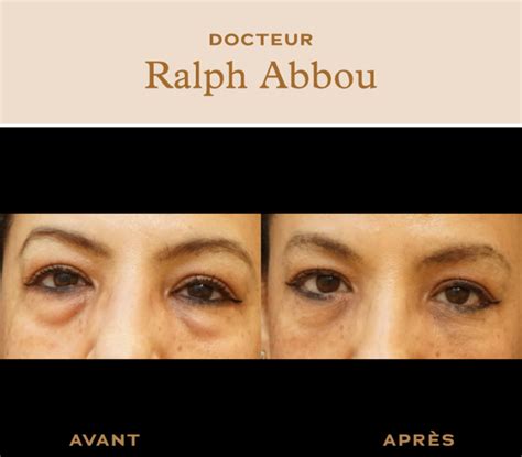 Traitement Des Poches Sous Les Yeux Dr Ralph Abbou